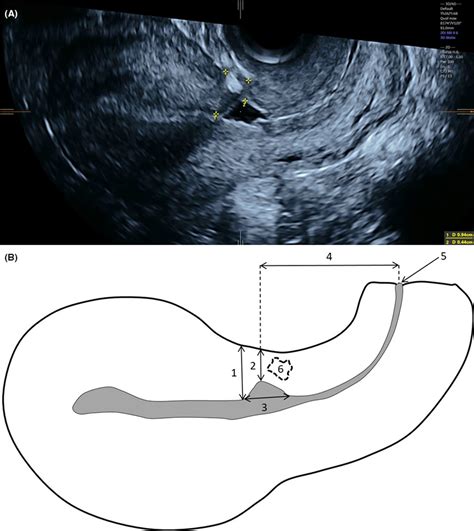 cesarean scar scar thickness measurement ultrasound|cesarean section scar assessment.